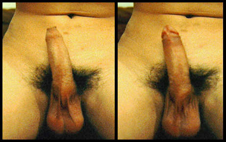 An intact penis erect with the foreskin covering and retracted